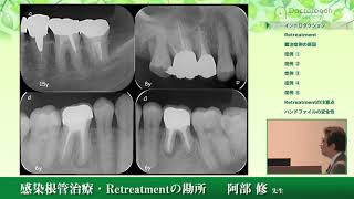 感染根管治療 〜retreatmentの勘所〜 #1【阿部修先生】