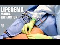 Manual lipedema extraction  dr jaime schwartz  total lipedema care