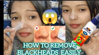 How To Remove Blackheads And Whiteheads From Nose Trendy Pooja Rajpoot 