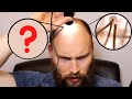 Balding Hair vs "Normal" Hair - Miniaturization In Male Pattern Baldness