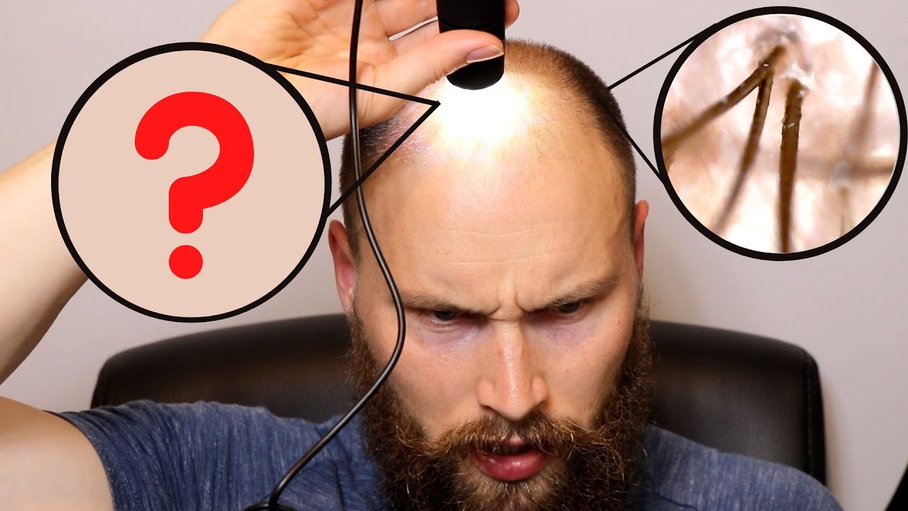 Balding Hair Vs Normal Hair Miniaturization In Male Pattern 