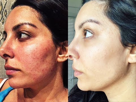 HOW I GOT RID OF ACNE SCARS | Microneedling Experience