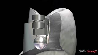 029 - Extra coronary resilient attachment