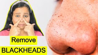 Remove Blackheads, Whiteheads, Large Pores At Home- Blackheads Removal- Priya Malik screenshot 3