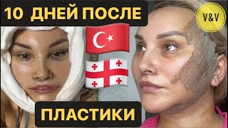 10й ДЕНЬ ПОСЛЕ ПЛАСТИЧЕСКОЙ ОПЕРАЦИИ В ТРАБЗОНЕ СНЯЛИ ШВЫ #пластикалица #подтяжкалица