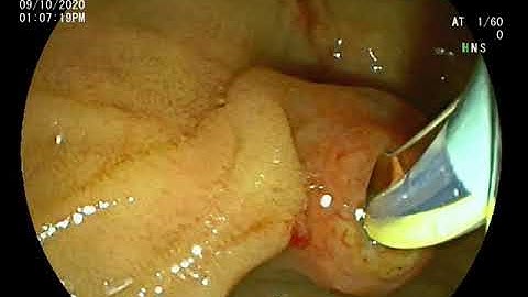 ERCP by Rendezvous technique