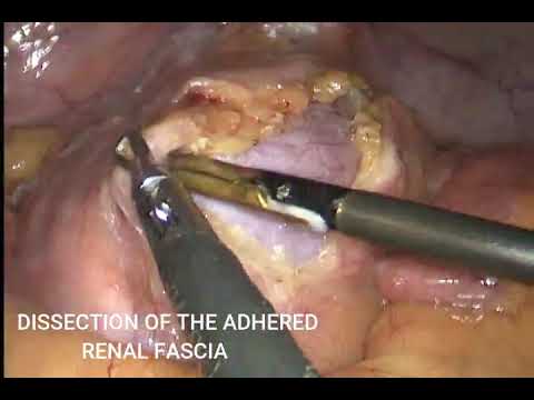 LAPAROSCOPIC ASSISTED PCNL FOR A LEFT ECTOPIC PELVIC KIDNEY STONE 3 CM BY DR HARSHAWARDHAN TANWAR