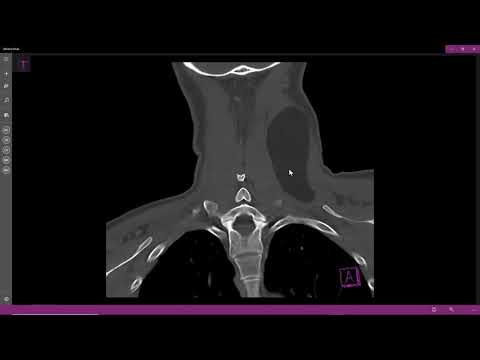 Vídeo: Características De La TC Espectral De Energía Dual En El Adenocarcinoma De Pulmón Resecado Quirúrgicamente: Comparación Entre Mutaciones De Oncogén Viral Del Sarcoma De Rata De Kir