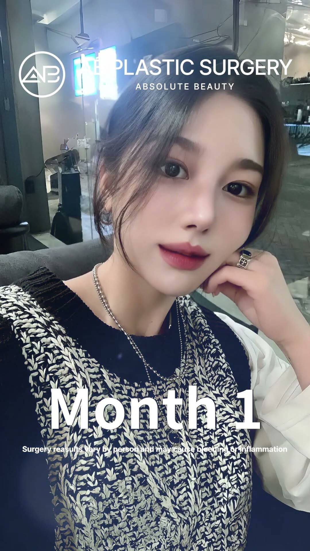 Unbelievable Nose Job Transformation You Won’t Recognize Her #shorts