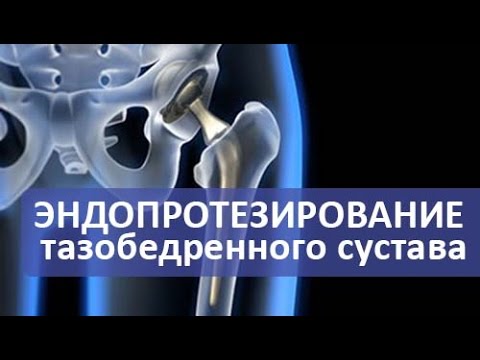 Эндопротезирование тазобедренного сустава видео ход операции видео thumbnail