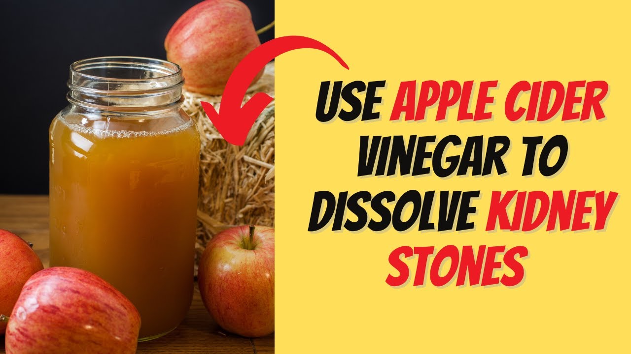 Use Apple Cider Vinegar to Dissolve Kidney Stones in 2023 YouTube