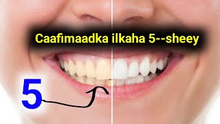 Caafimaadka-- Ilkaha 5--Taan Sheey Ma Sameeysaa ??