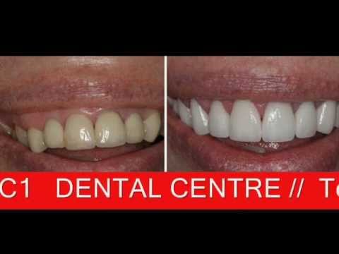  Whitening, Broken Teeth, Broken Tooth Repair - Execudent - YouTube