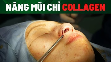 Nâng mũi bằng chỉ collagen có an toàn không | Bác sĩ Trọng