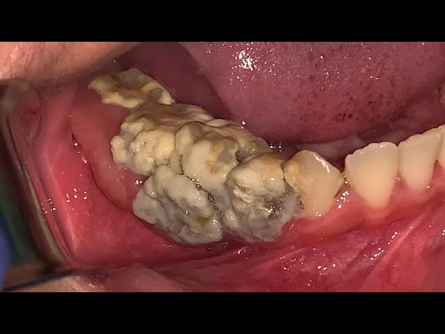 Giant Tartar | Karang Gigi | Dentist | Dokter Gigi Tri Putra