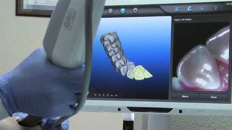 Digital Impressions:  iTero Orthodontic Scanner