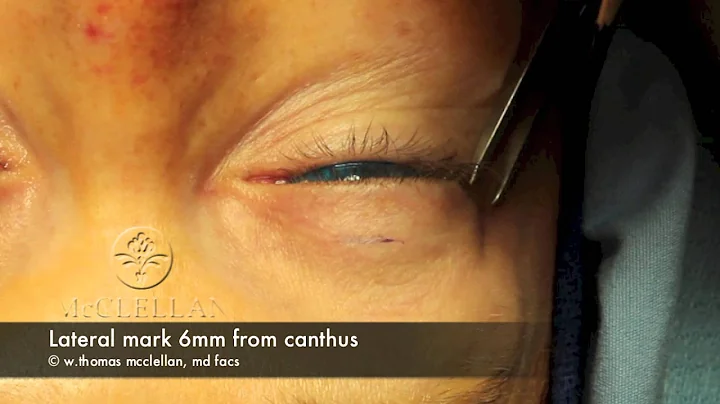 Live Surgery: Upper Blepharoplasty (Eyelid Lift) P...