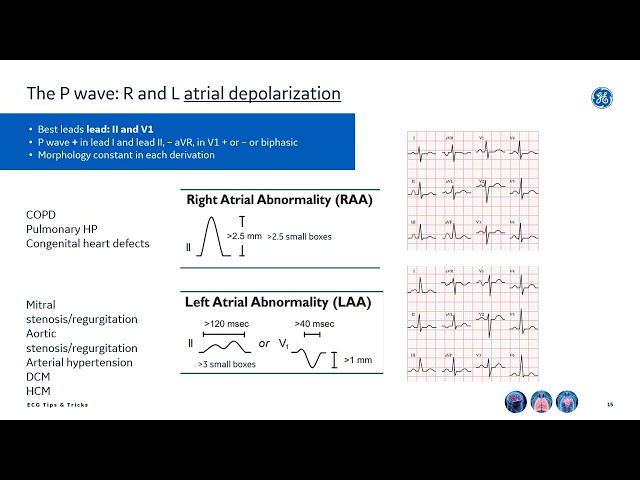 Watch A simple ECG interpretation method to cope during a terrible night shift - ECG tips and tricks on YouTube.
