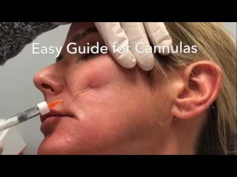 Easy Guide System for Blunt Cannulas - Dermal Fillers - Steven F Weiner, MD