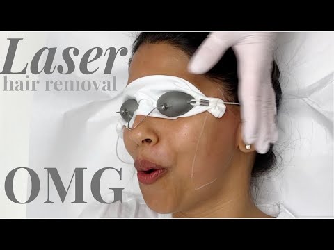 I did LASER HAIR REMOVAL all over my FACE!