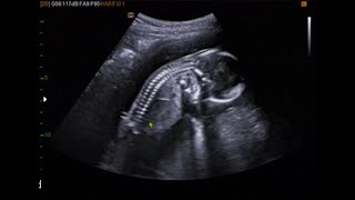 fetal ultrasound of 16 weeks 17 weeks baby boy moving