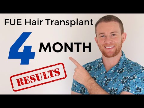 4 Month FUE Hair Transplant Results