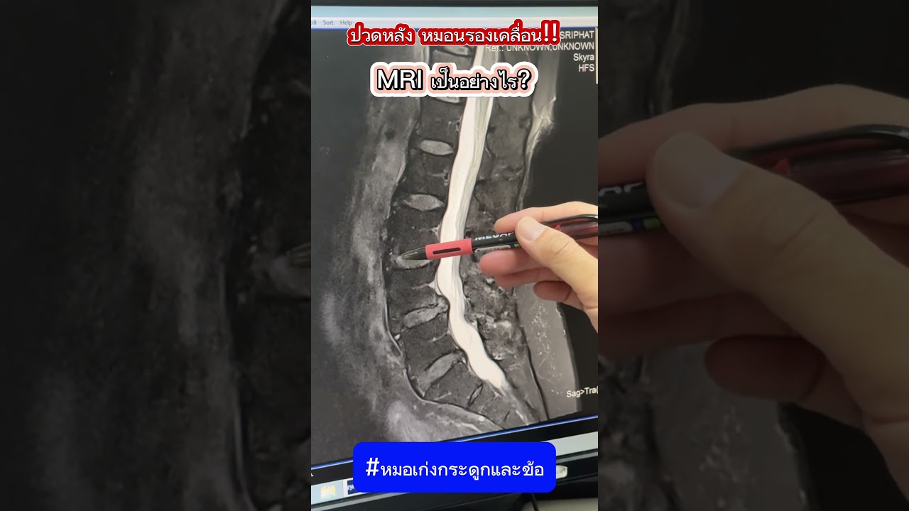 ปวดหลัง หมอนรองกระดูกเคลื่อน MRI เป็นอย่างไร? #หมอเก่งกระดูกและข้อ #ปวดหลัง #MRI #หมอนรองกระดูก