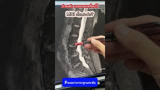 ปวดหลัง หมอนรองกระดูกเคลื่อน MRI เป็นอย่างไร? #หมอเก่งกระดูกและข้อ #ปวดหลัง #MRI #หมอนรองกระดูก