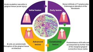 Periodontal Pathogenesis / Part 1
