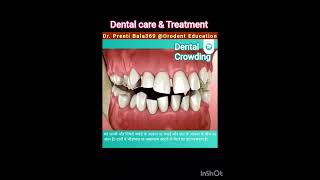 Dental Crowding