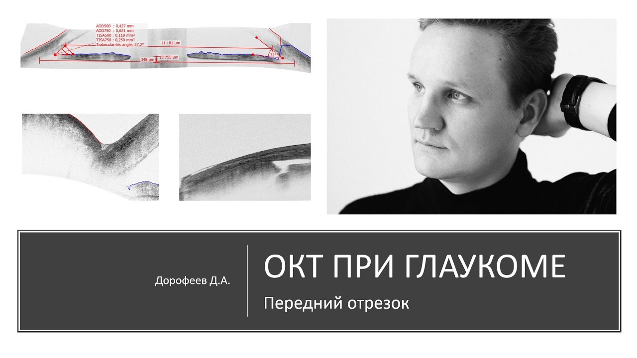 Клапан ахмеда при глаукоме