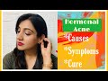 HORMONAL ACNE - Causes, Symptoms & Solution|| Skin Care Tips Treating Hormonal Acne|| Stay Beautiful