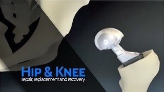 What is a Hip Replacement: Rapid Recovery Hip Replacement