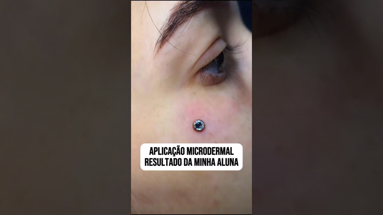 Microdermal realizado pela minha aluna e o resultado ficou incrível 😍 