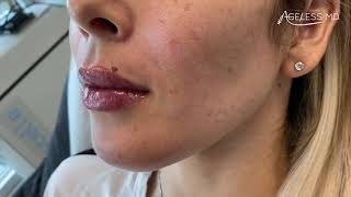 Lips Filler Pano By Ageless Md