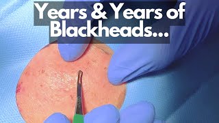 Super Satisfying Removing YEARS Old Cheek Blackheads! | CONTOUR DERMATOLOGY
