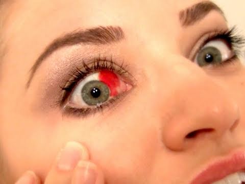 How long does it take an eye hemorrhage to heal?