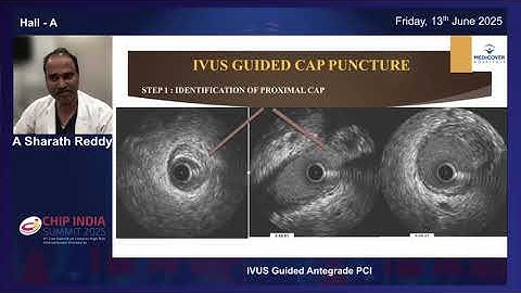 IVUS-guided antegrade wiring of CTO - Live lecture by Dr. Sharath Reddy