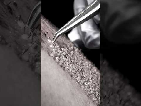 عجب تراکمی کاشت مو با ارائه ضمانت نامه کتبی در کلینیک تهران بیوتی سنتر 02179958 کاشت مو