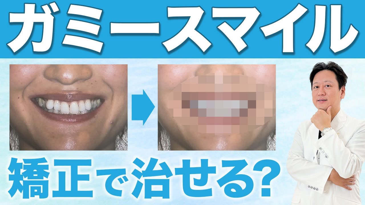 ガミースマイルは矯正で本当に治る？仮性・逆の原因と治療法を解説