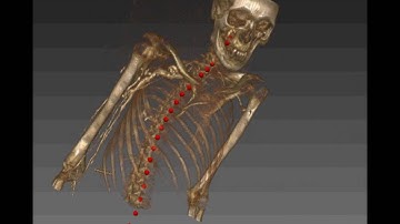 Automatic Vertebrae Localization in Arbitrary Field-of-View CT Scans