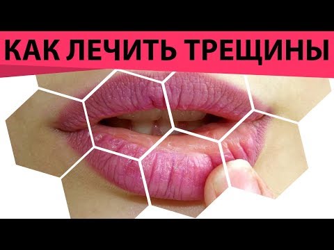 Трещины на губах. Почему губы трескаются и как лечить. Как мед лечит трещины на губах!