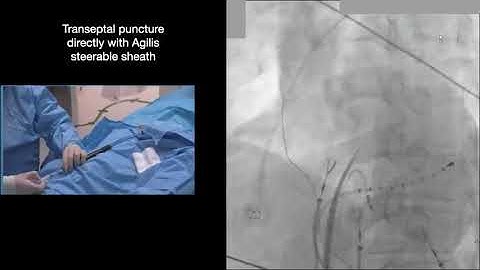 Step by step approach Trans septal puncture with #agilis #EPStudy #AF #ablation