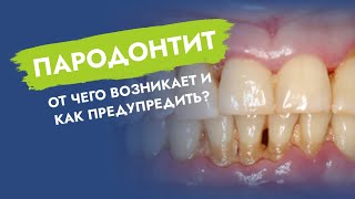 Пародонтит. От чего возникает и как предупредить?