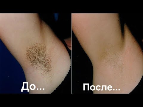 Быстро избавиться от волос в области подмышек/3 потрясающих рецепта