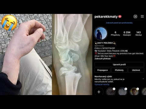 Video: Zlomil jsem si ruku?