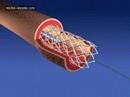 Coronary artery stenting