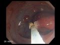 Non Familial Juvenile Polyposis Second Colonoscopy