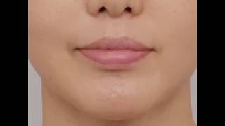 Ulthera อุลเซร่าเลเซอร์ ทำแล้วดึงหน้าได้ขนาดไหน Ulthera อุลเซร่าเลเซอร์ ทำแล้วดึงหน้าได้ขนาดไหน