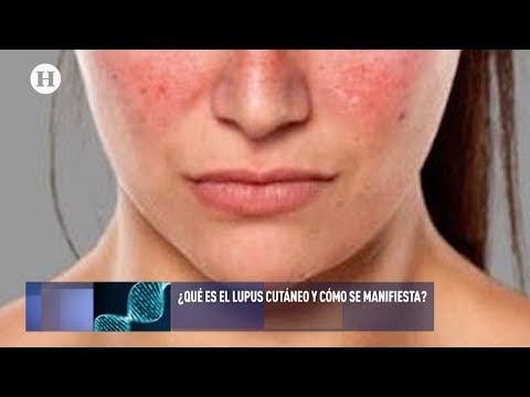 Vídeo: Lupus Discoide: Síntomas De Erupción Cutánea, Tratamiento Y Causas